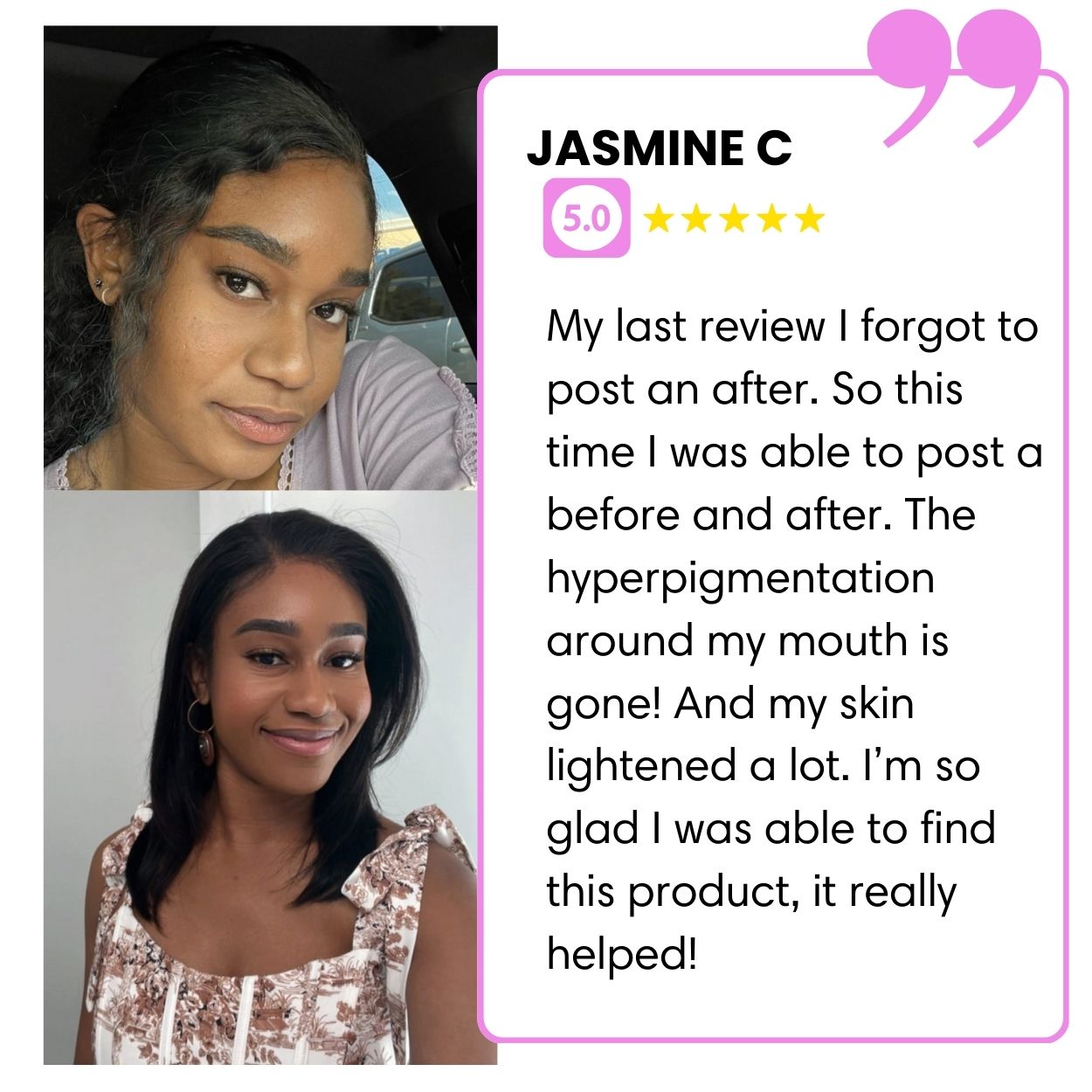 BIGGER EDITION: Jolie’s Full Body & Face Brightening / Acne Kit