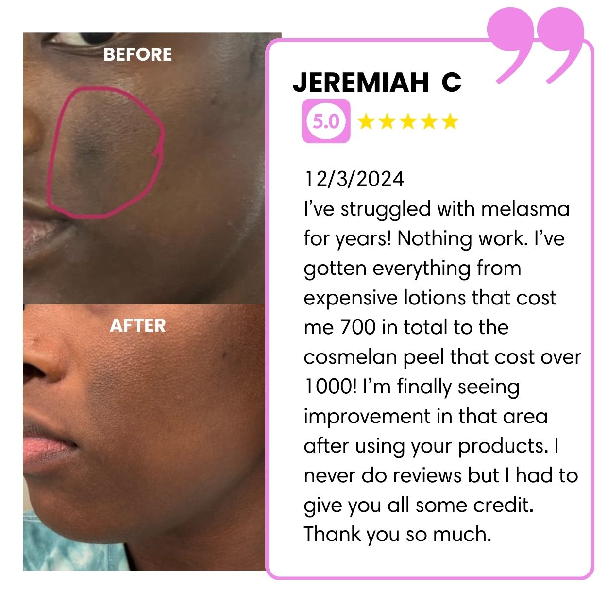 BIGGER EDITION: Jolie’s Full Body & Face Brightening / Acne Kit