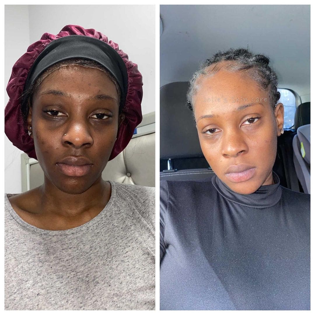 BIGGER EDITION: Jolie’s Full Body & Face Brightening / Acne Kit