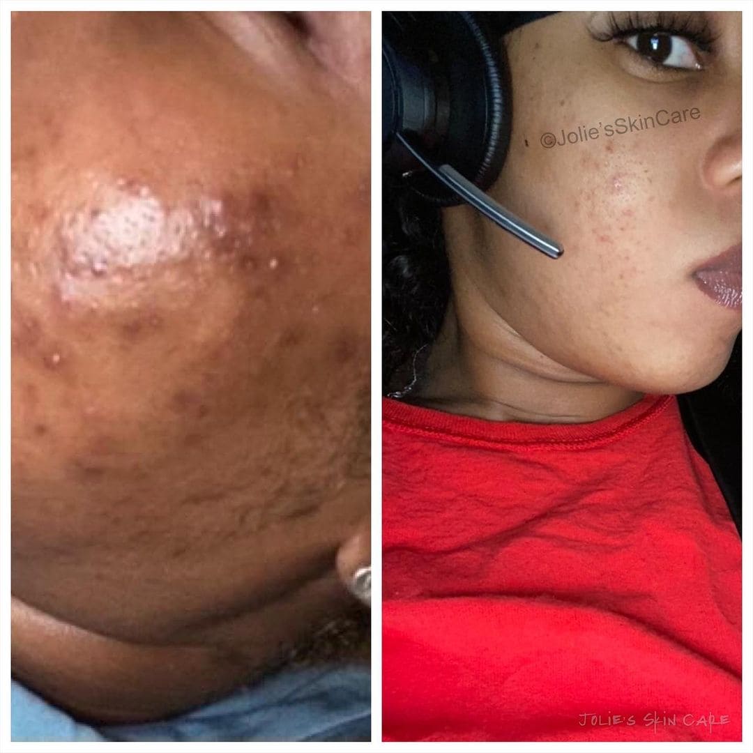 BIGGER EDITION: Jolie’s Full Body & Face Brightening / Acne Kit