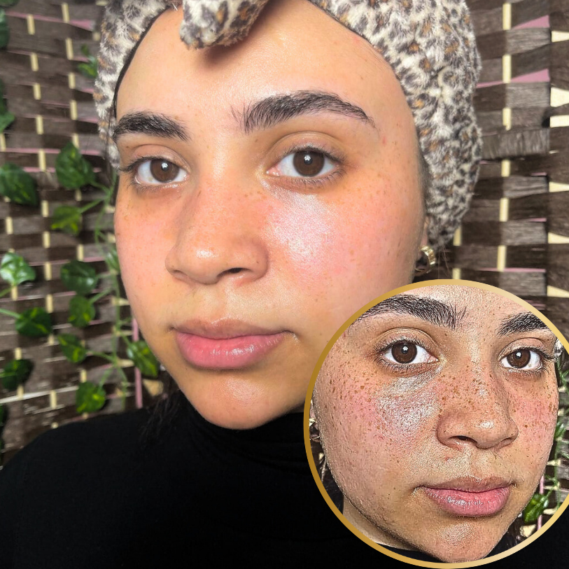 BIGGER EDITION: Jolie’s Full Body & Face Brightening / Acne Kit