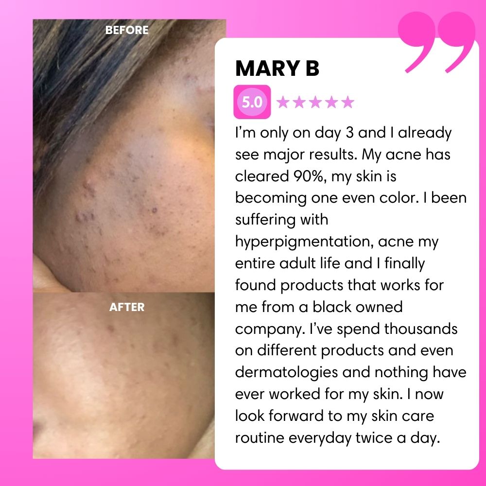 BIGGER EDITION: Jolie’s Full Body & Face Brightening / Acne Kit