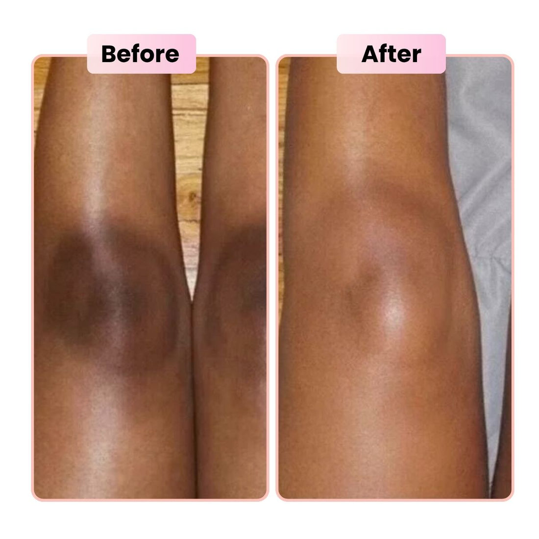 Knees & Elbows Darkening: Causes + Safe Routine to Even Tone