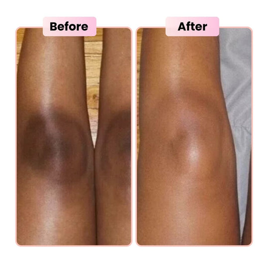 Knees & Elbows Darkening: Causes + Safe Routine to Even Tone