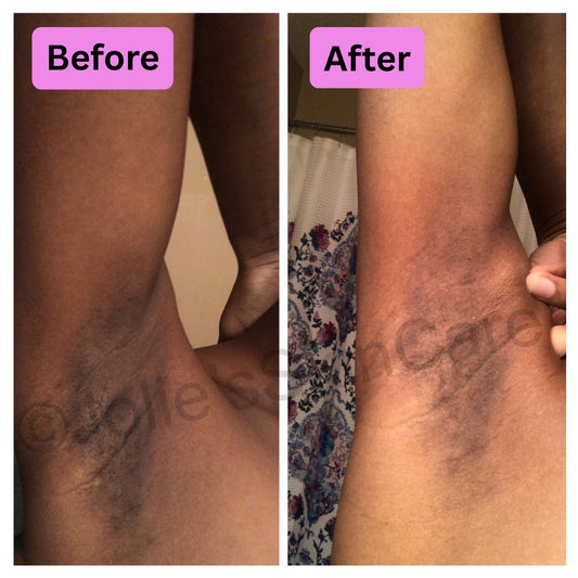 Underarm Hyperpigmentation: Deodorant, Friction & a Safe Brightening Routine