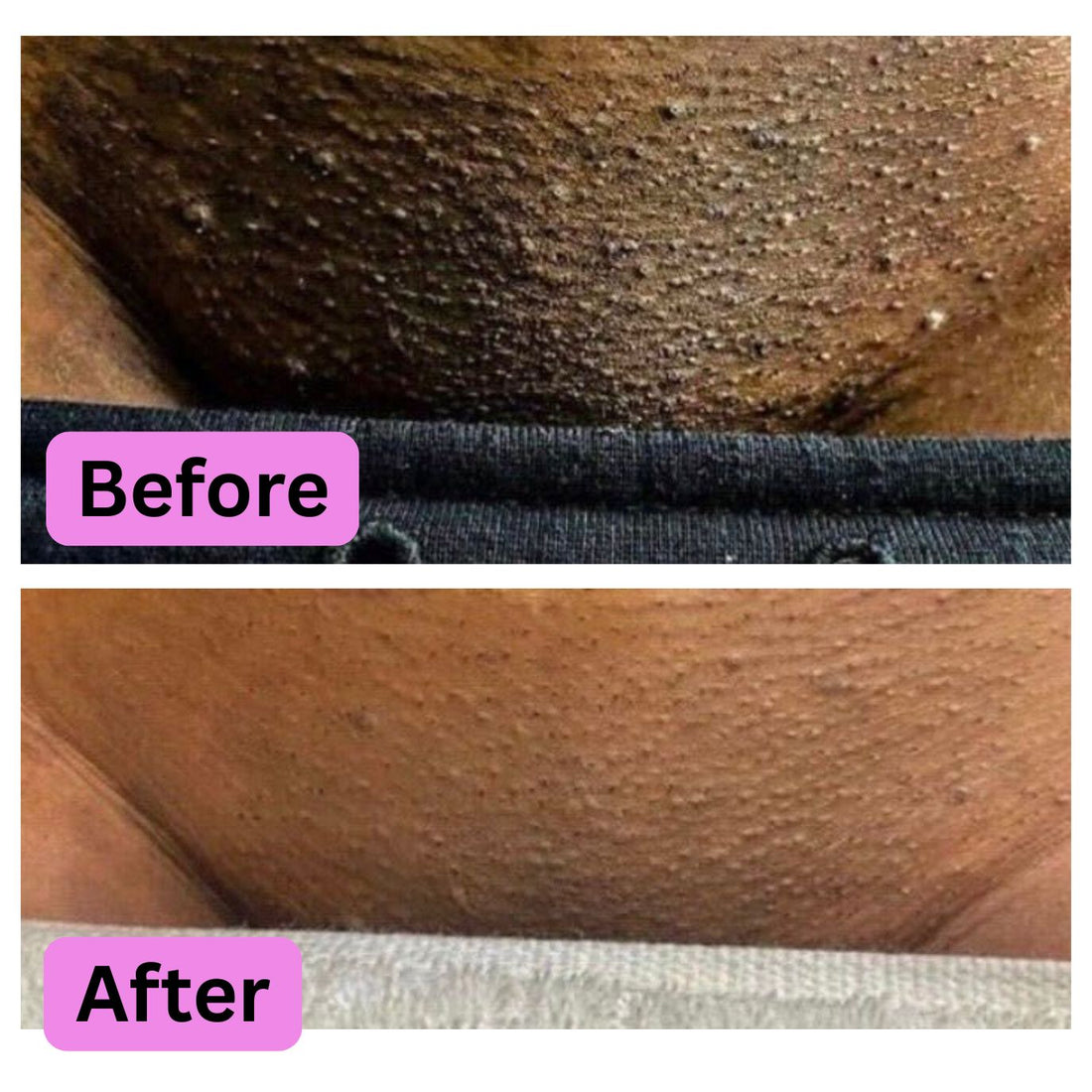 Bikini Line Hyperpigmentation: Causes & At-Home Routine