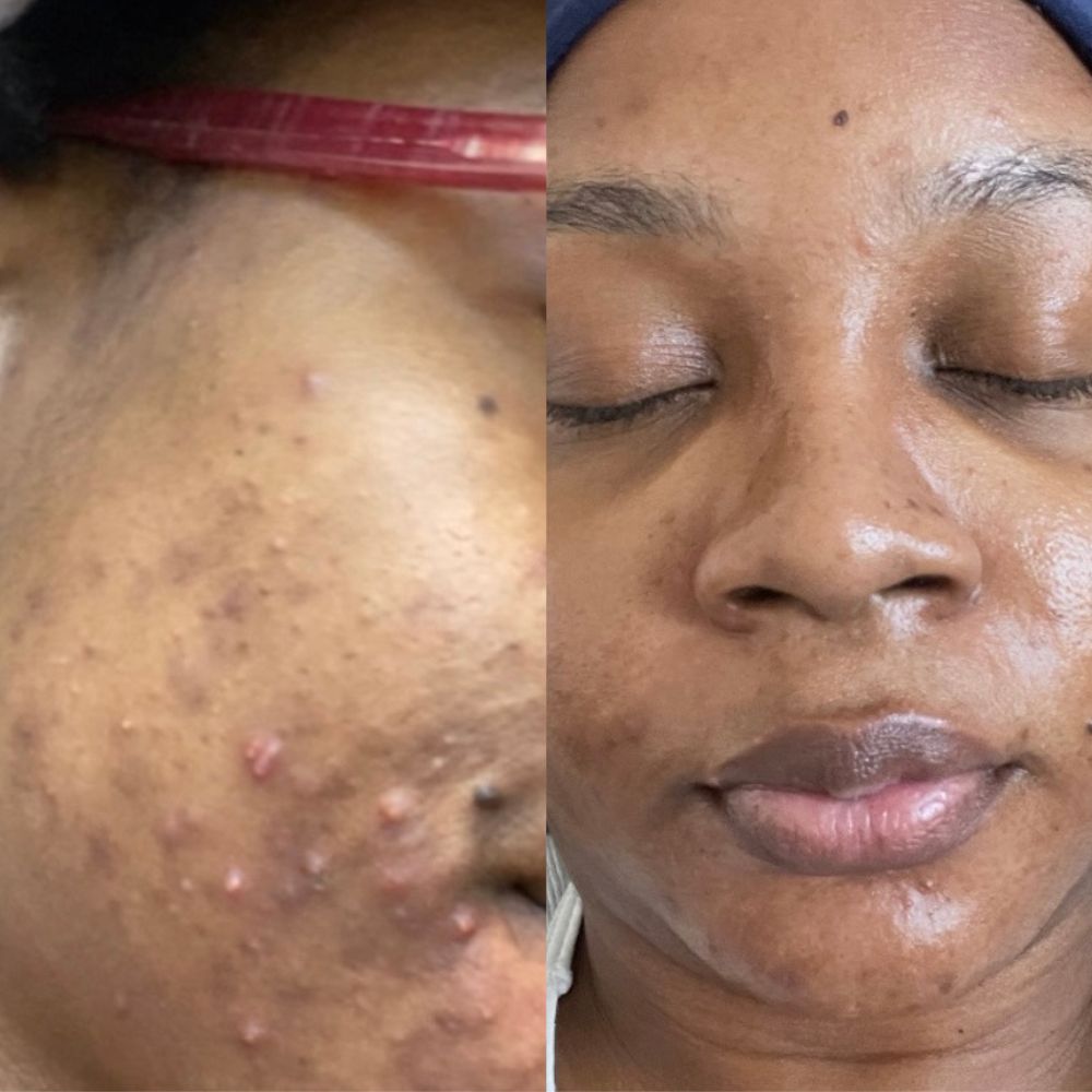 Dark Spot Timeline: What to Expect in 7–14–30 Days