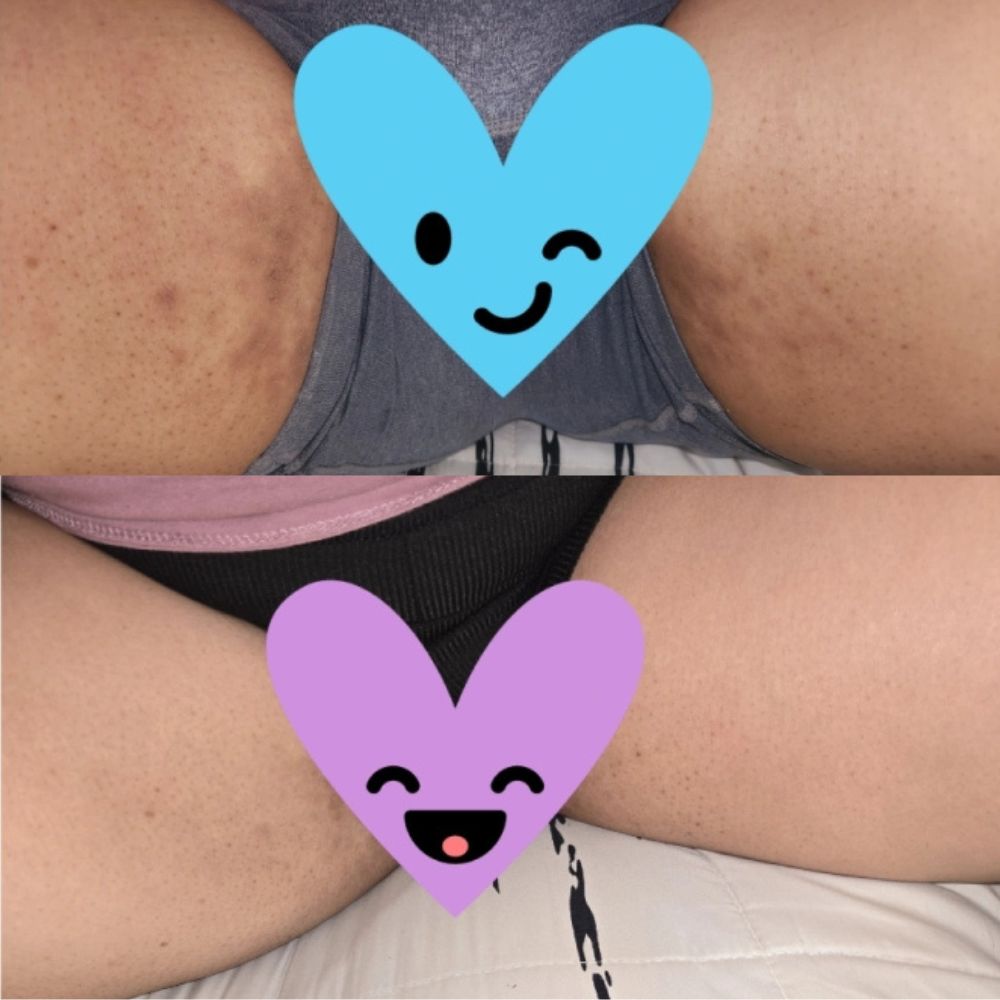 Inner Thigh Hyperpigmentation (From Chafing): Causes & a Barrier-Safe Routine