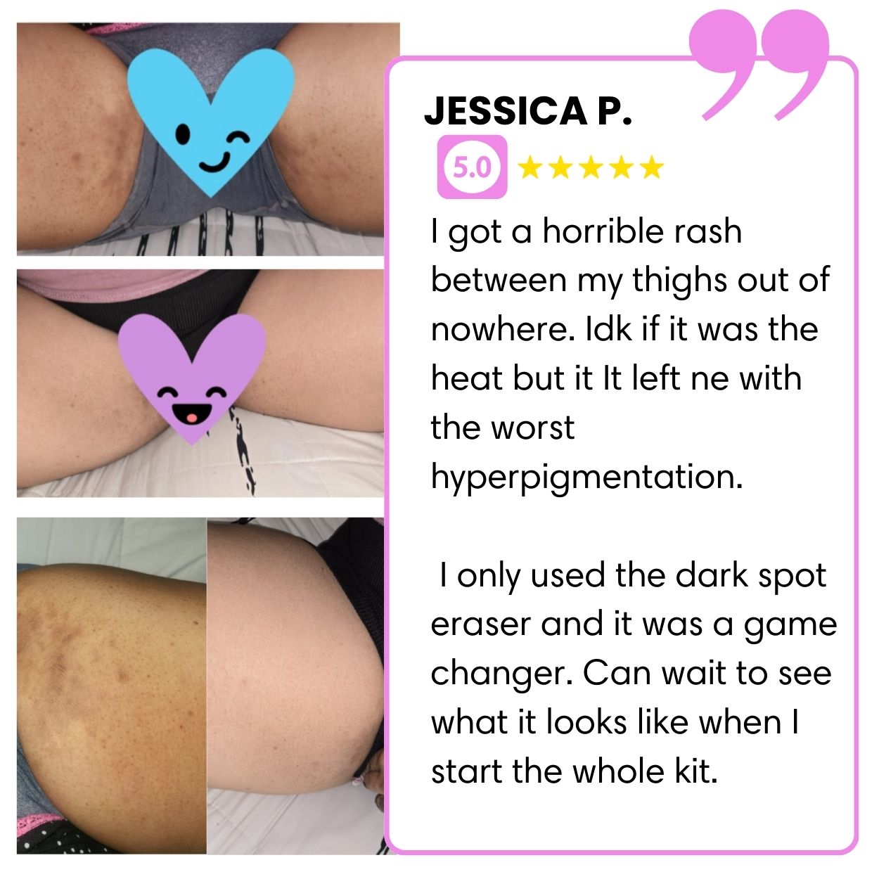 Dark Spot Eraser Lotion and Exfoliating Soap + FREE PAPAYA X VIT C FACIAL CLEANSER