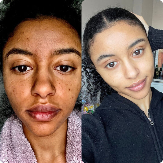 BRIGHTENING & HYPERPIGMENTATION FACIAL (75 minutes)
