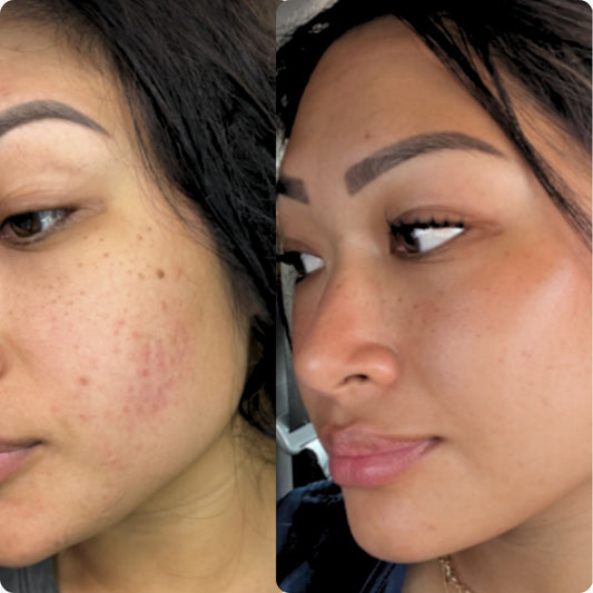 ACNE CLARIFYING FACIAL (75 minutes)